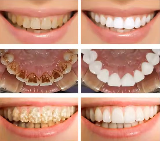 ✨ LANBENA Teeth Whitening Mousse – 60 ml